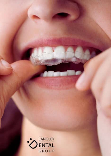 invisalign langley
