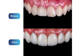 Langley Dental Crown Dental Crown langley #LangleyDentalGroup #BestDentalClinic #LangleyDentist #DentalCareLangley #LangleyOralHealth #TopDentistLangley #LangleyDentalServices #DentalExpertsLangley #LangleyDentalTreatment 