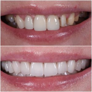 Dental Bonding Langley
#LangleyDentalGroup
#BestDentalClinic
#LangleyDentist
#DentalCareLangley
#LangleyOralHealth
#TopDentistLangley
#LangleyDentalServices
#DentalExpertsLangley
#LangleyDentalTreatment
#HealthySmileLangley @LangleyDentalGroup
@BestDentalClinicLangley
@TopDentistLangley
@LangleyOralCare
@LangleyDentalExperts
@LangleyDentalProfessionals
Dr Shahdad Ayoughi best dentist