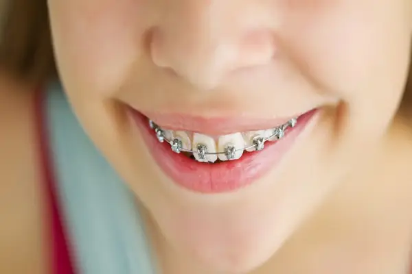 A girl who has orthodontics