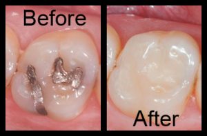 Dental Tooth Coloured Filling Langley 