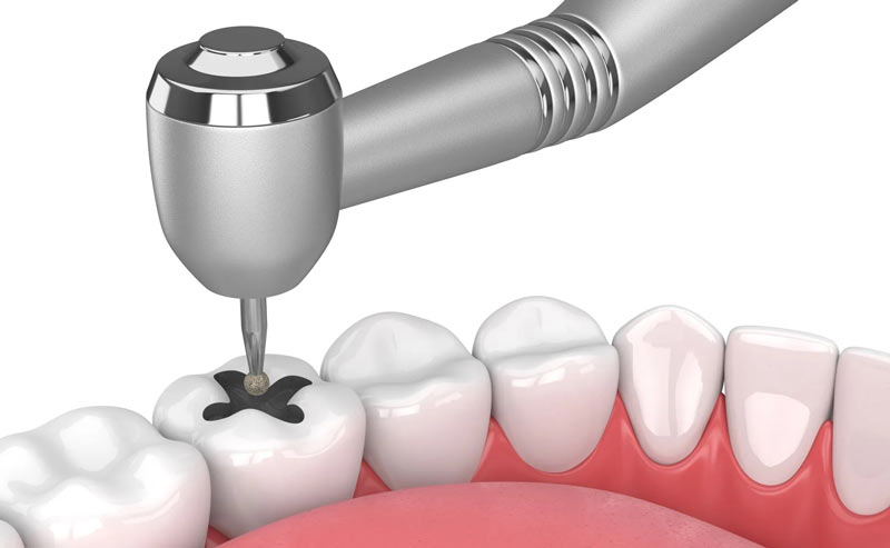 Direct dental Restorations
