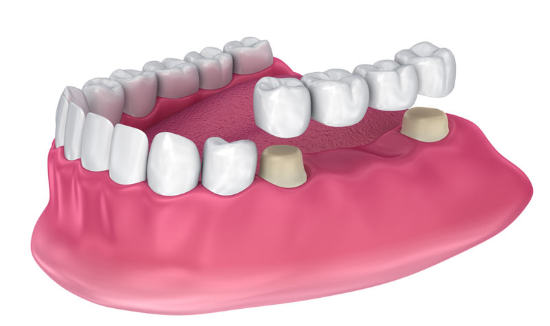 Indirect Dental Restorations