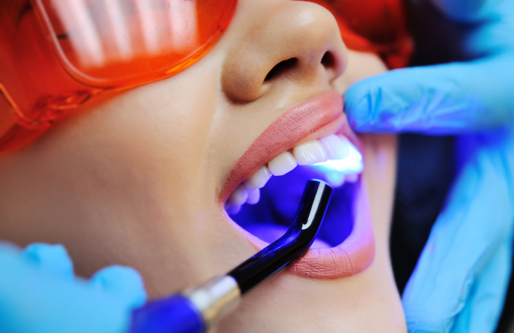 a patient receiving teeth whitening treatment on the front teeth