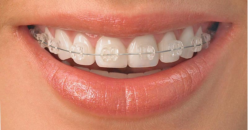 Clear Ceramic Braces