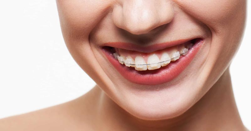 Clear Ceramic Braces