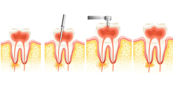 Signs You Need a Root Canal