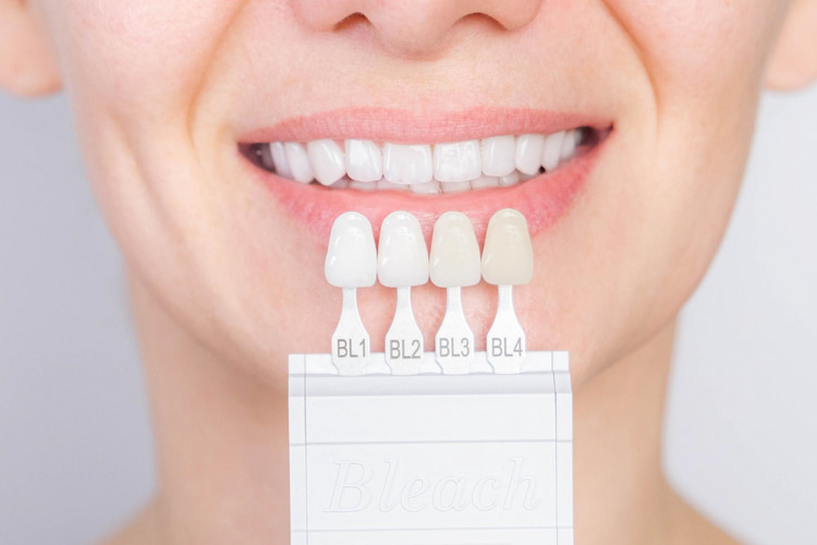 a person holding different shades of dental veneers in front of their smile.