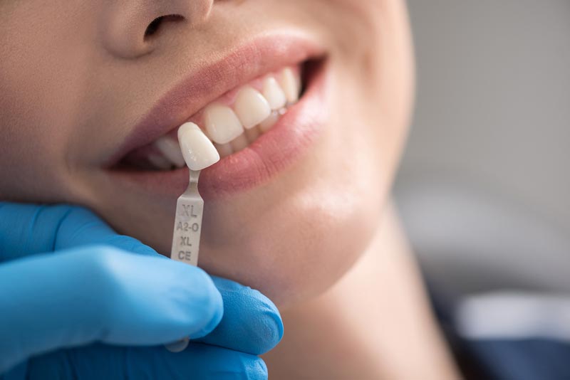 Are Veneers a Permanent Solution?