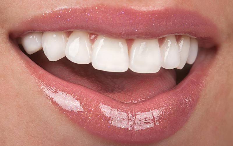 Are Veneers a Permanent Solution?