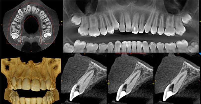 Dental CBCT Scan