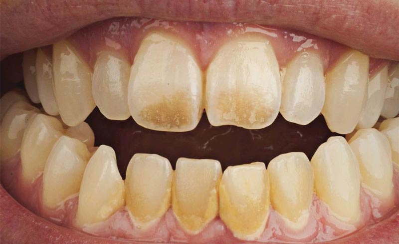 Does veneers ruin your teeth?