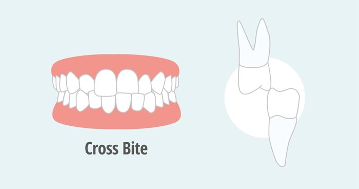Treatment for Crossbite