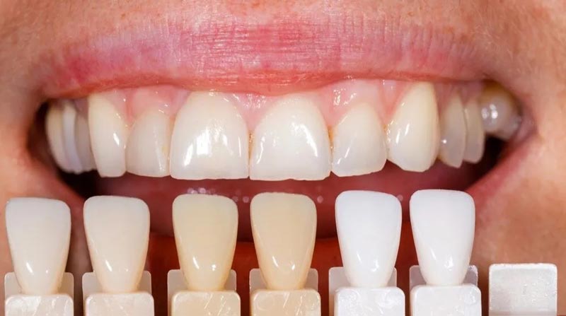 Do Veneers Ruin Your Natural Teeth?