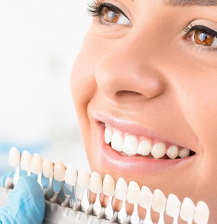 dental veneers Langley