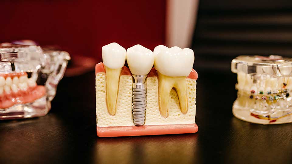 Root Canal Dentist Near Me