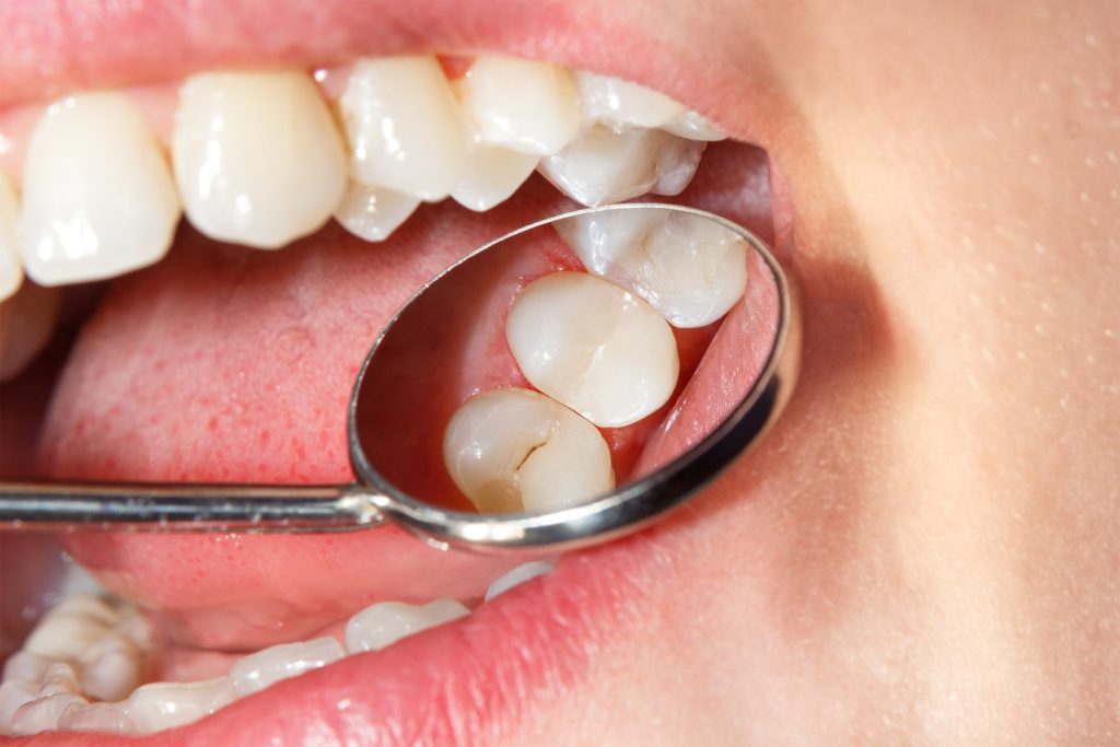 Are Tooth Fillings Painful? What to Expect and Everything You Need to Know