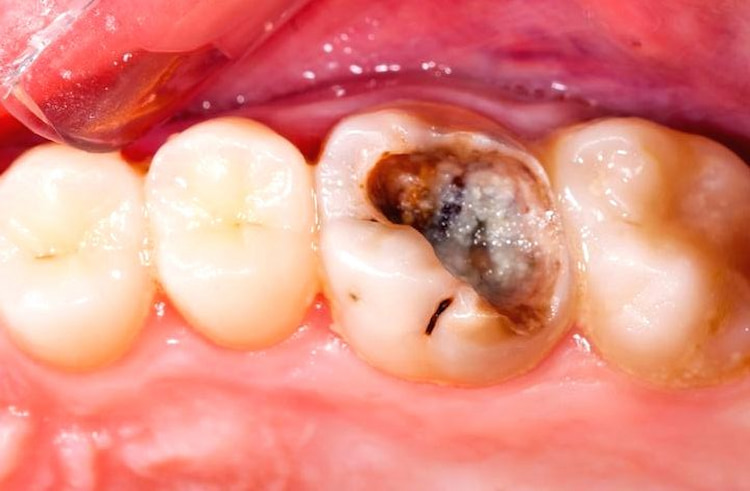 What do cavities look like on teeth? a row of 4 teeth among which one of them has a decayed dentin.