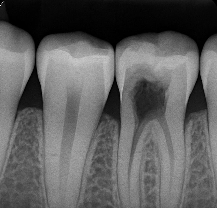 a dental x-ray showing that a tooth's pulp is damaged because of cavities.