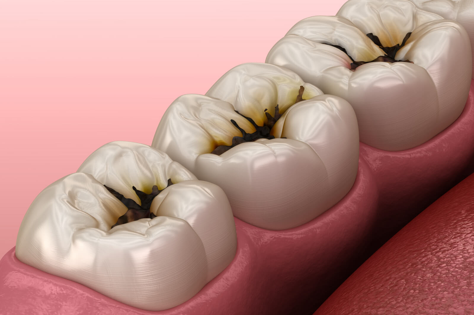 What Does a Cavity Look Like? - My Dentist Langley