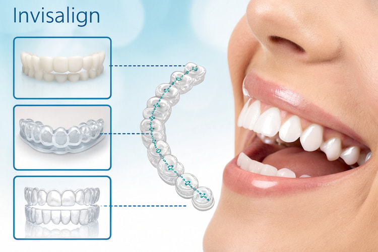 What Is Invisalign?