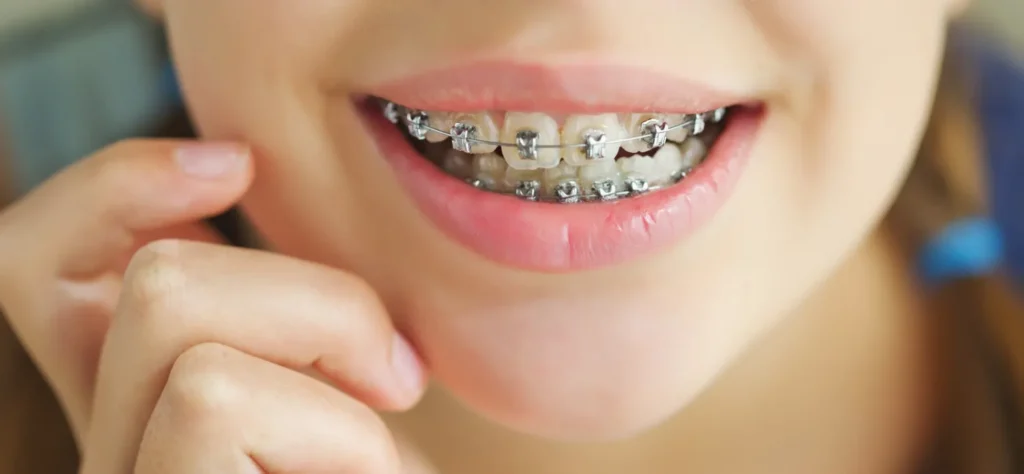 orthodontics langley