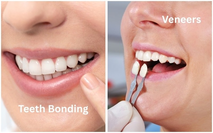 comparing veneers vs bonding