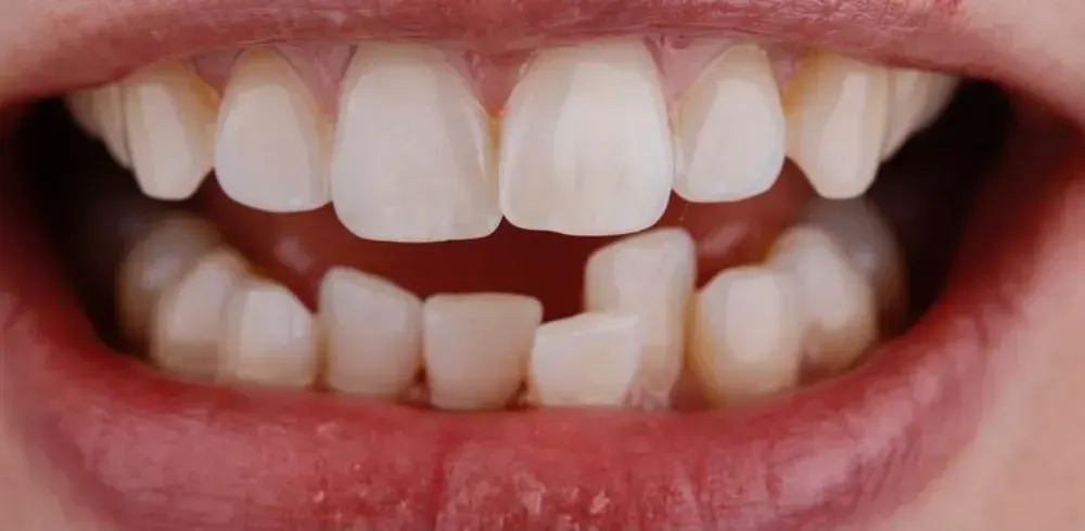 before invisalign langley before invisalign langley