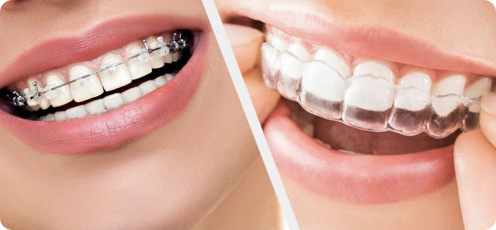 Invisalign® Langley