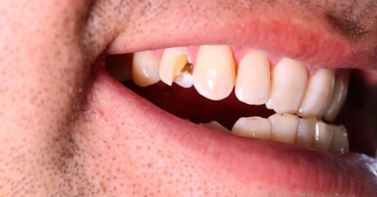 Cracked Tooth Dental Emergency: When Seconds Save Smiles