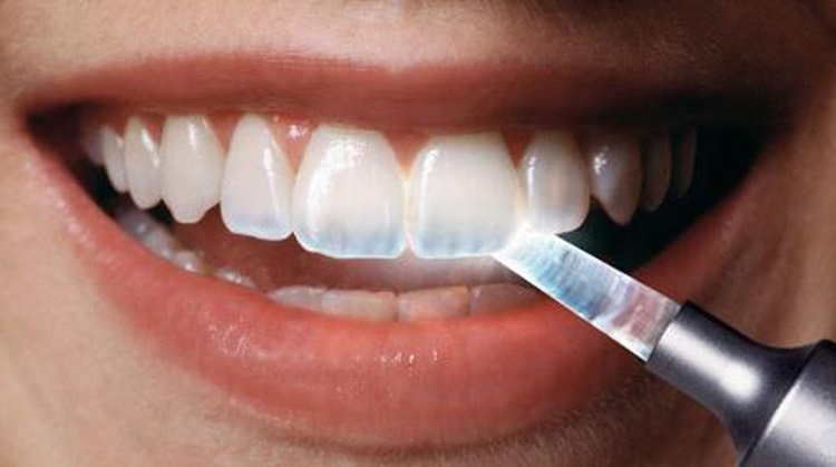 Enamel Wears Away, a cause of sensitive teeth