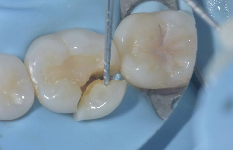 Fractured Cusps, a type of cracked tooth