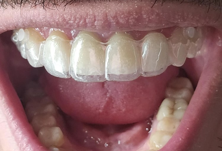 At-Home Clear Aligners