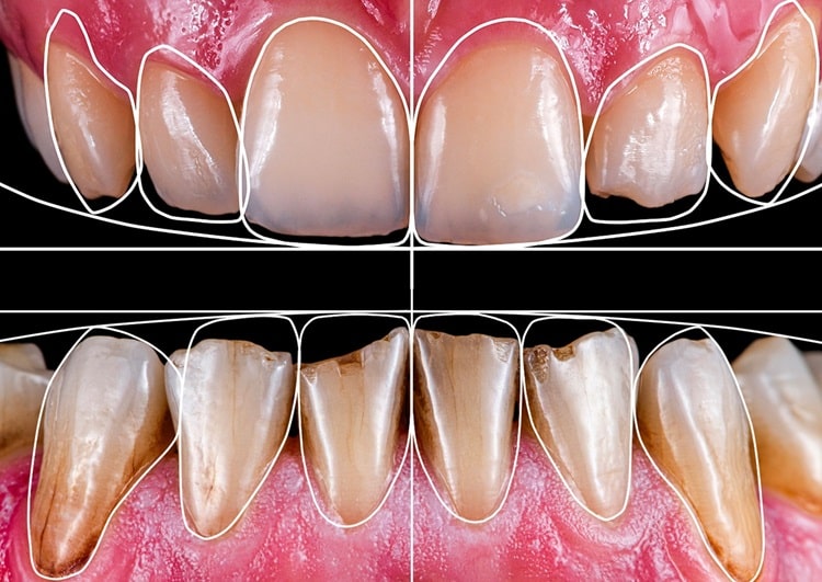 a digital smile makeover