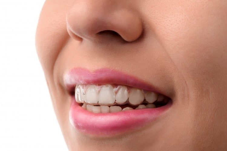 look of Invisalign for Teens