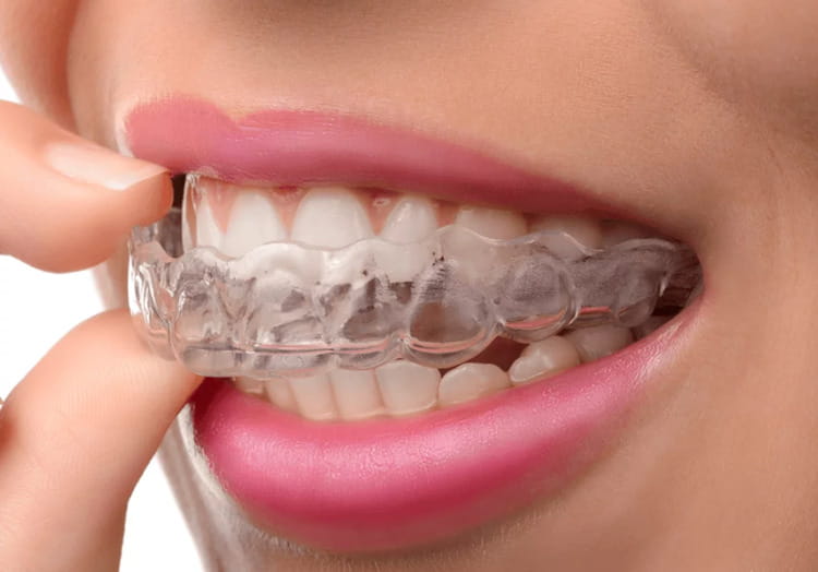 Clear Aligners