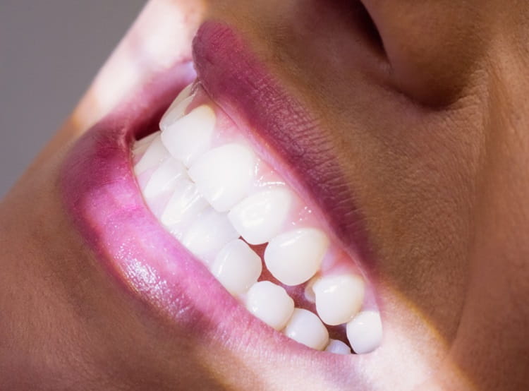  Teeth Whitening cost