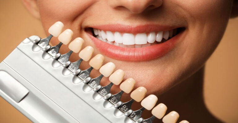 What to Expect from Porcelain Veneers