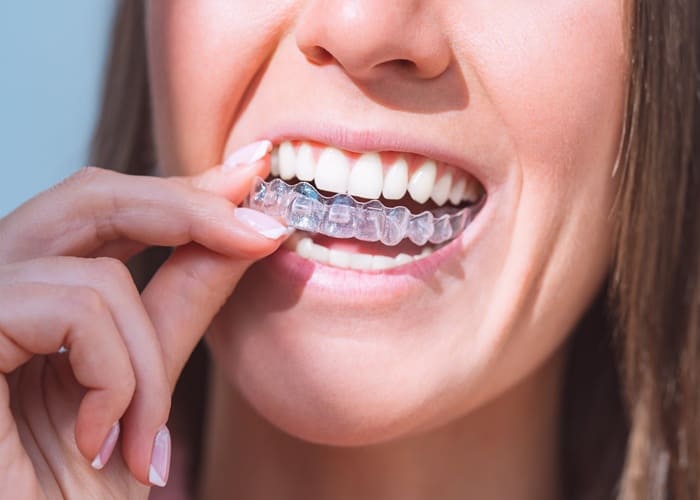 Invisalign or Clear Orthodontics