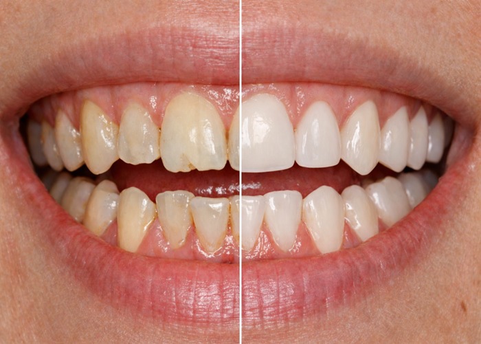 dental veneers vs natural tooth