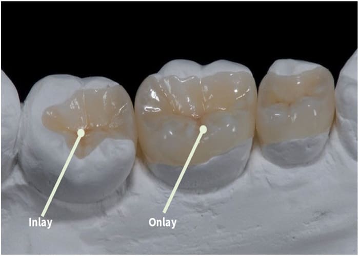 Dental Inlays & Onlays