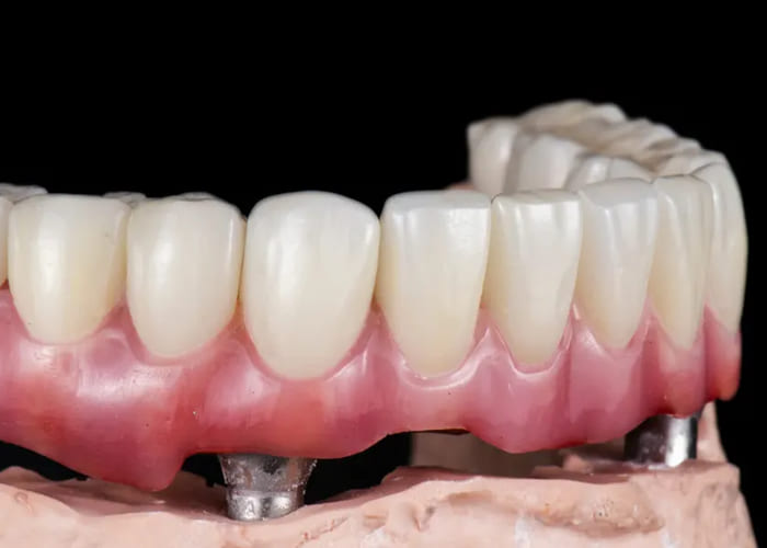 digital dental implants