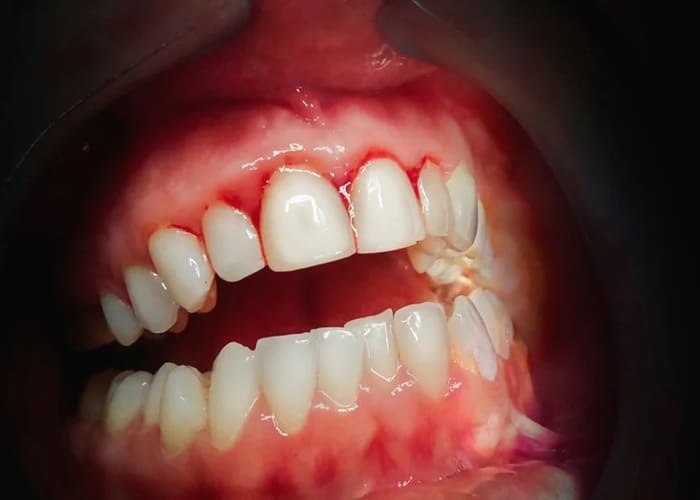 bleeding gums