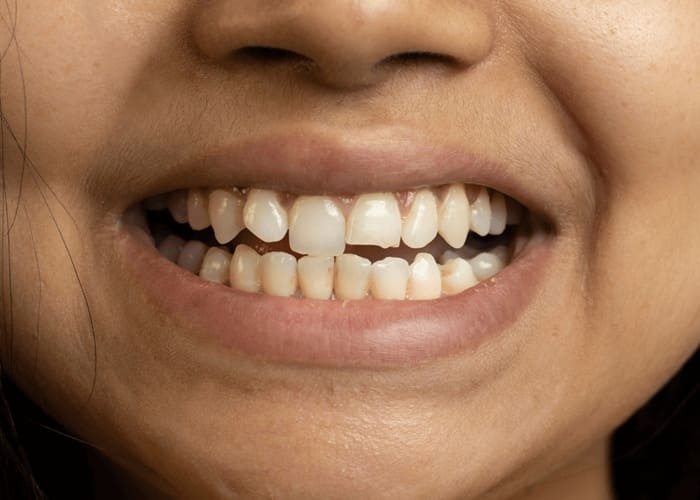 broken tooth