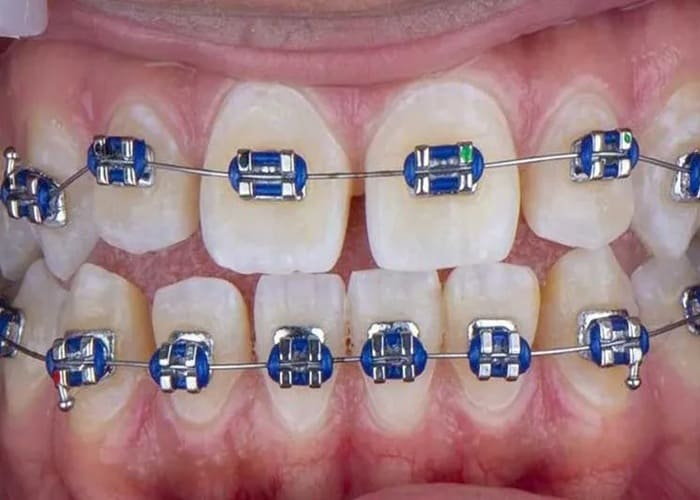 Accumulation of tartar and plaque with orthodontic