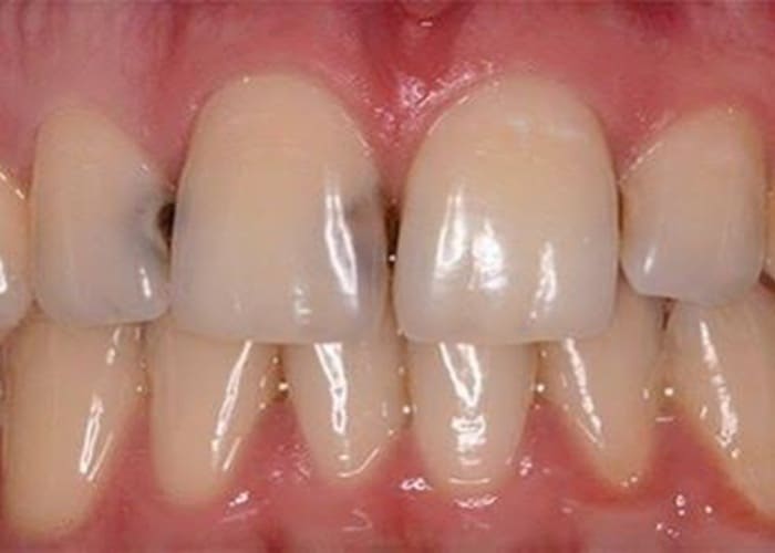Hidden cavities after braces are removed