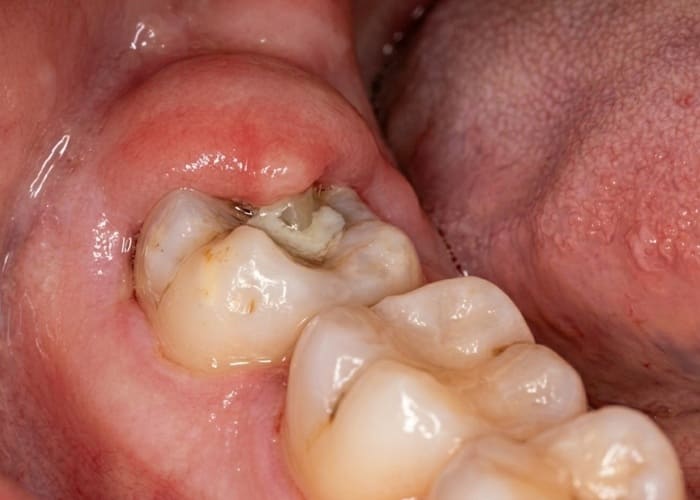 Infection and pus discharge from around the wisdom tooth