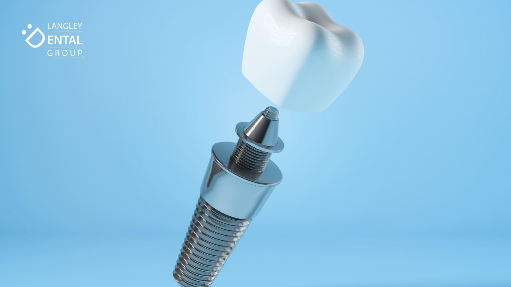 implants procedure