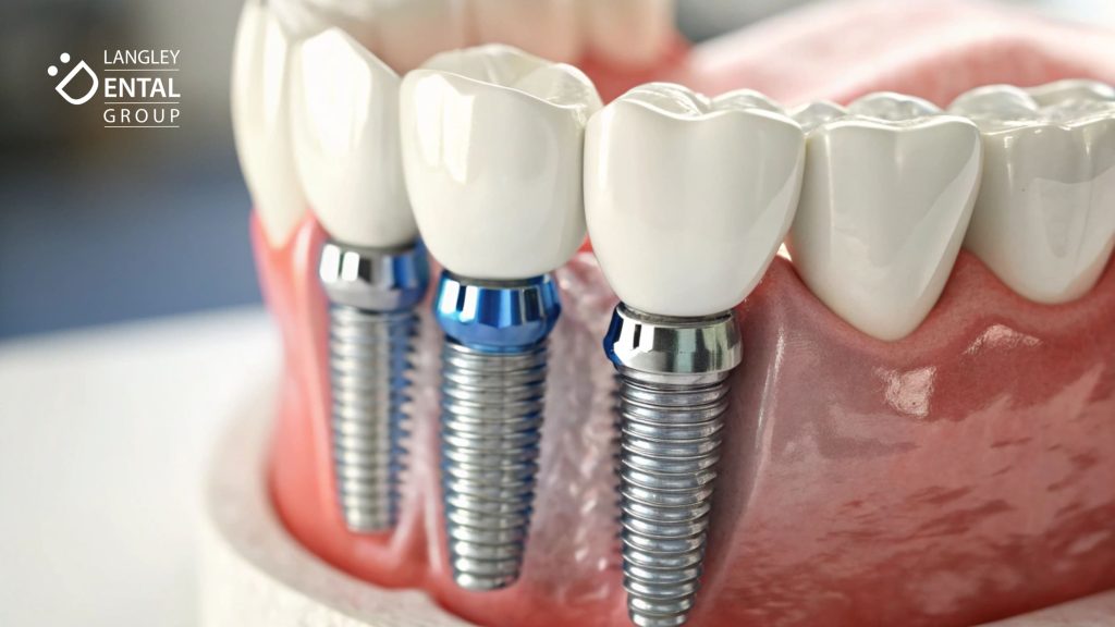 dental bridges vs implants in Langley