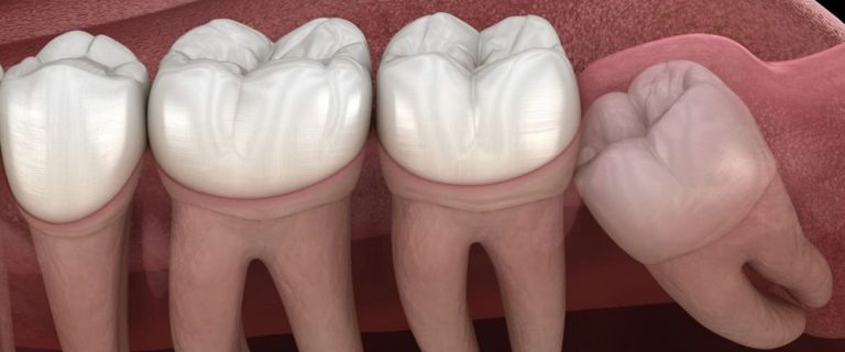 Wisdom Tooth Removal Signs